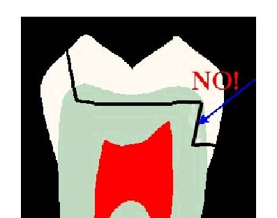 This prevents access to properly condense into retention grooves