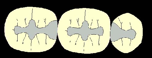 Extension for prevention includes enamel defects such as decalcifications, defective and non-coalesced pits and fissures