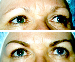 Eyebrow Enhancement Image