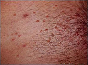 hot naked mallu videos molluscum contagiosum penis