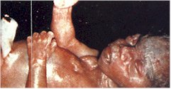 Aborto prostaglandinas