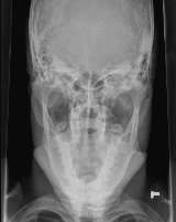 Mastoids x ray