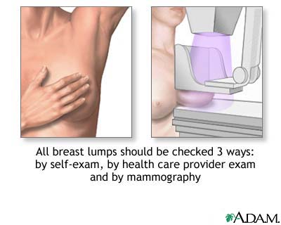 breast lump and pain Breast lump and pain