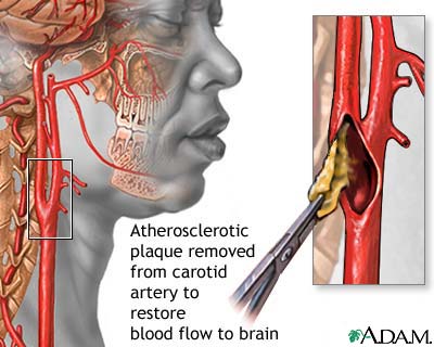 Trinny woodall boob Carotid douloureux endarterectomy facial nerve