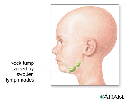 lump inside neck that moves lump inside neck that moves
