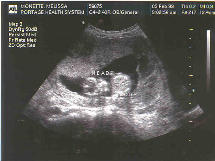 sonogram 5 weeks. measured 13 weeks 6 days.