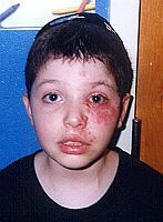 scar face