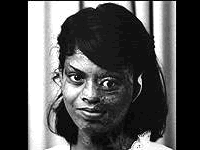acid victim