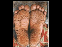 arsenic poisoning