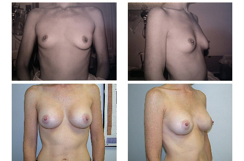 275cc breast implants. after reast augmentation