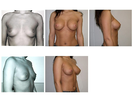 breast augmentation pictures. after reast augmentation