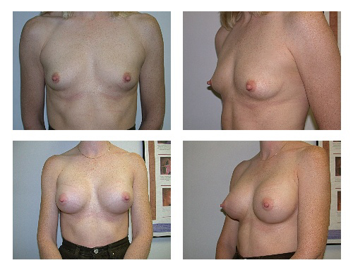 breast implants before and after. Top Row: Before breast