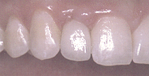 after dental implant