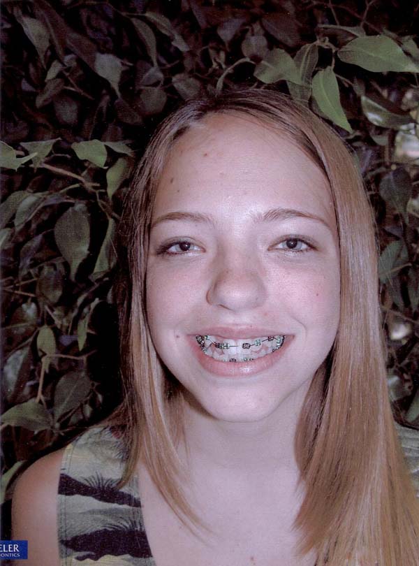 bracesjpg 02Oct2003 2145 67k 