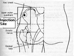 Steroid injection sites tricep