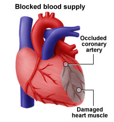 hva er hjerteinfarkt test