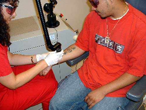 TATTOO REMOVAL