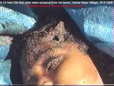 burnt body of a boy