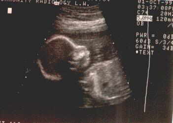 20 Weeks