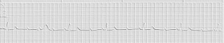 EKG background