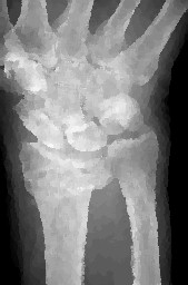 <x-ray of a wrist>