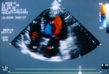 LV Thrombus