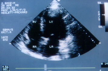 LV Thrombus