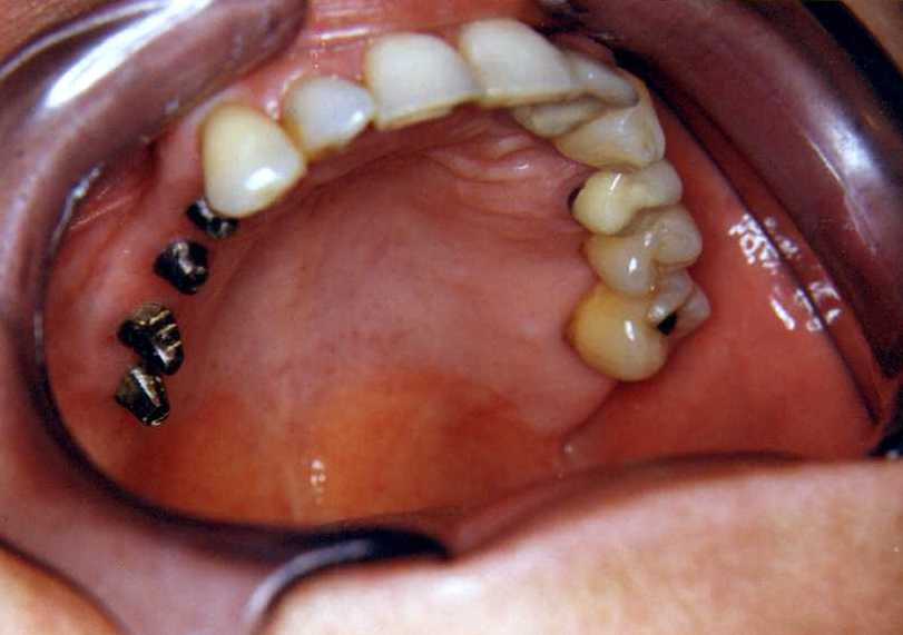 1impl.jpg (29731 bytes)