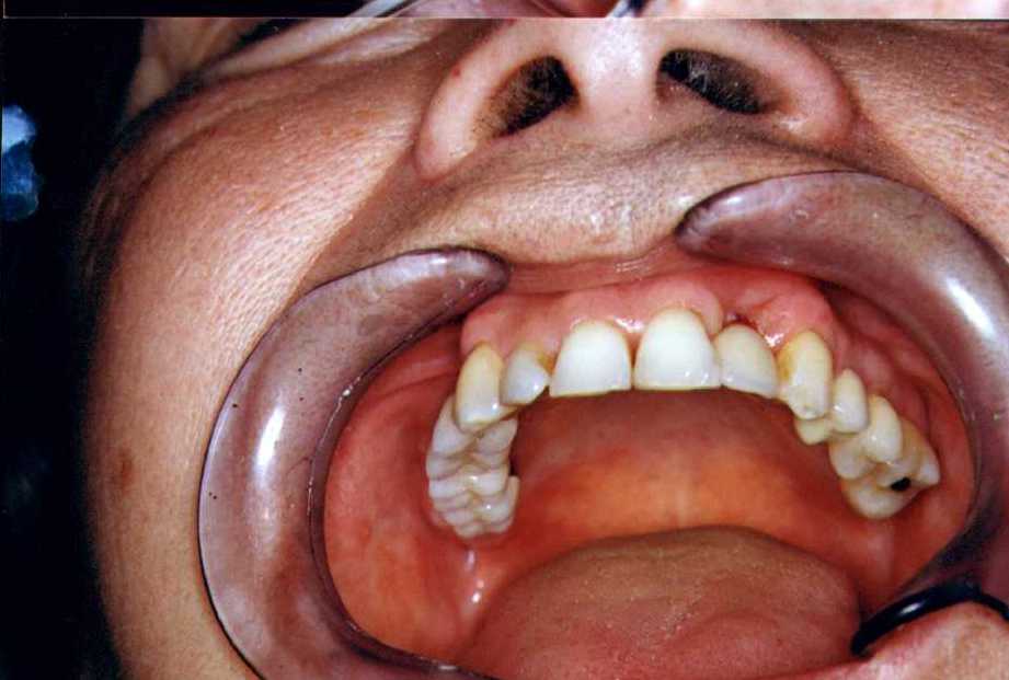 2impl.jpg (46574 bytes)