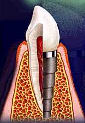 2impl2.jpg (8433 bytes)