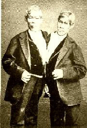 Click here to see Siamese Twins pictures