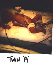 twin 'A'