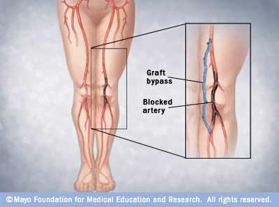Illustration showing graft bypass for peripheral arterial disease