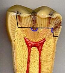 Affected dentin, e.g., tertiary dentin, is NOT infected dentin and should NOT be removed
