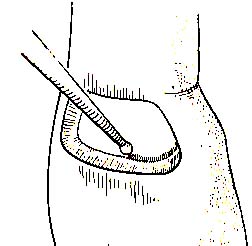 Occlusal and gingival walls alone do not provide retention form