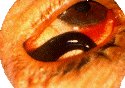 Eyeworm