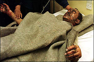 from BBC- burn victim of bombing raids