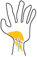 Tendons don't hold up well to shards of glass.......