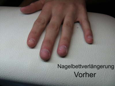 Nagelbettverl�ngerung Vorher