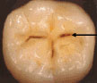 Dental Caries