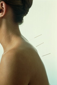 Picture of a woman receiving acupuncture