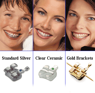Options for Braces