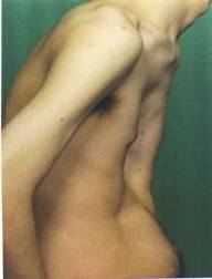 Ravitich - Pectus Excavatum - Pre-op