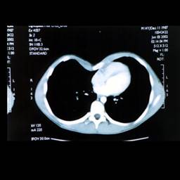 CT Scan
