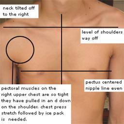 analyzed pectus 1