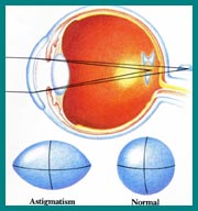 normal vs. astigmatic cornea