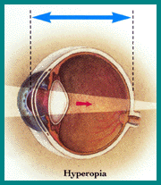 picture of hyperopic
		 eye