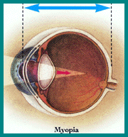 picture of myopic eye