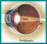 picture of presbyopic eye