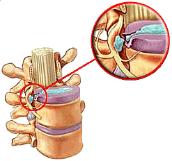 Herniated Disc